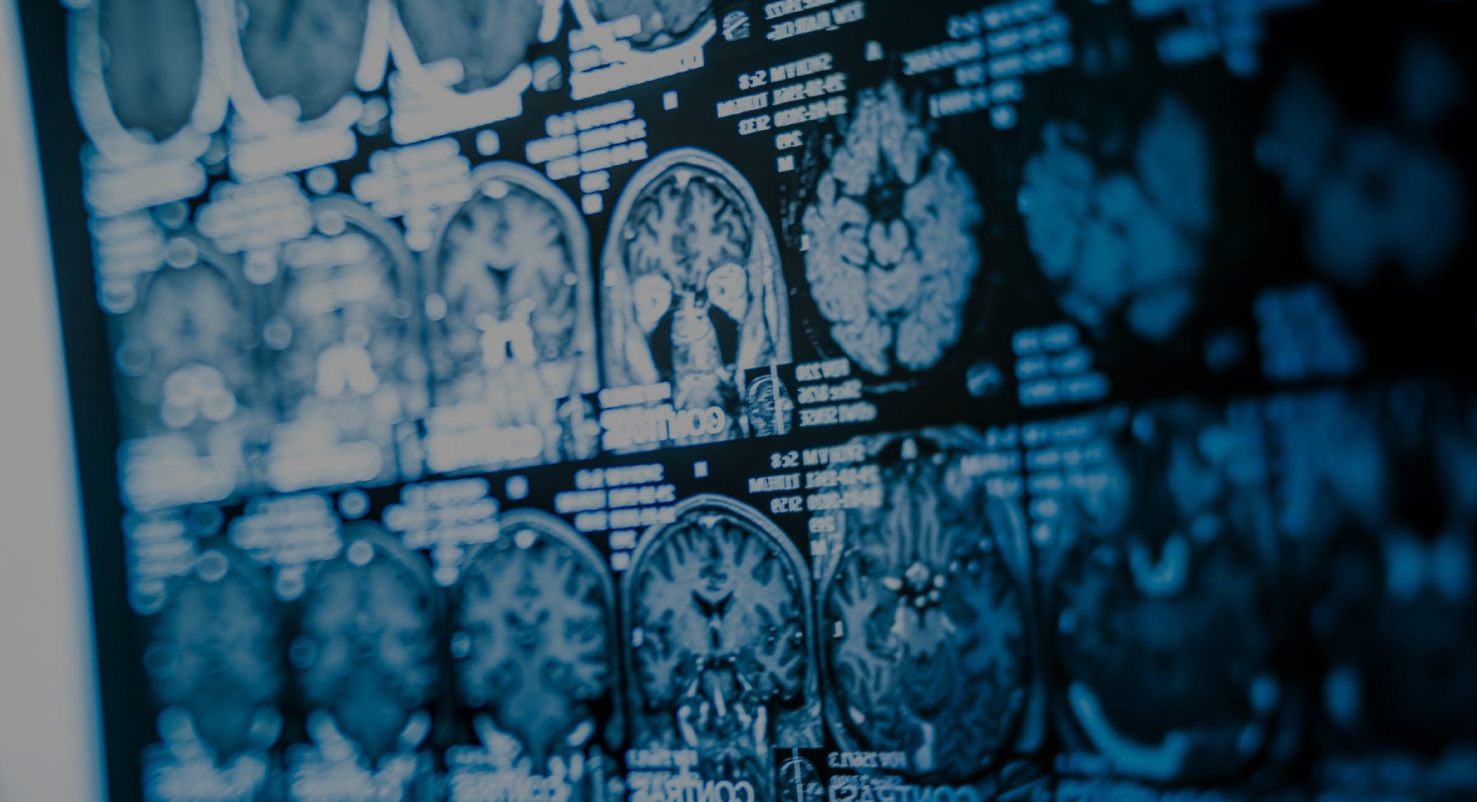 Lower Pressure HBOT in Chronic Brain Injury