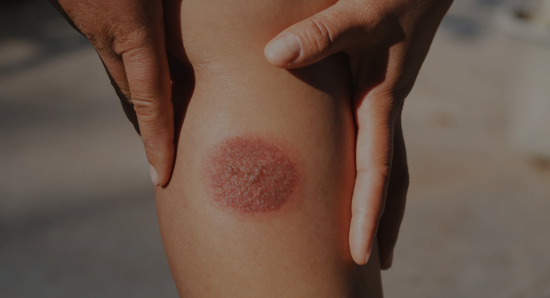 The Benefits of Hyperbaric Oxygen Therapy for Late Radiation Injury